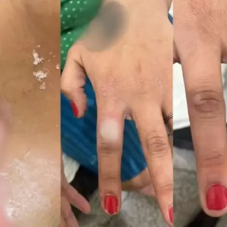 HOMEM É PRESO SUSPEITO DE ATEAR FOGO À COMPANHEIRA APÓS SE IRRITAR POR ELA TER PINTADO AS UNHAS DE VERMELHO