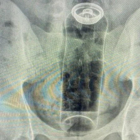 JOVEM É INTERNADO APÓS FICAR COM DESODORANTE PRESO NO ÂNUS E MÉDICO ALERTA PARA RISCOS