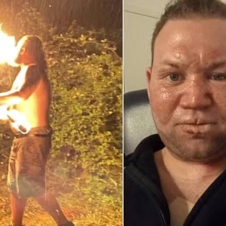 CUSPIDOR DE FOGO AMADOR SOFRE ACIDENTE DURANTE CHURRASCO E ACABA QUEIMADO: ‘MEU ROSTO DERRETEU’