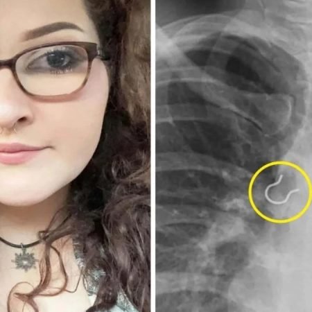 MULHER DESCOBRE OBJETO BIZARRO NO PULMÃO APÓS MESES DE TOSSE INTENSA