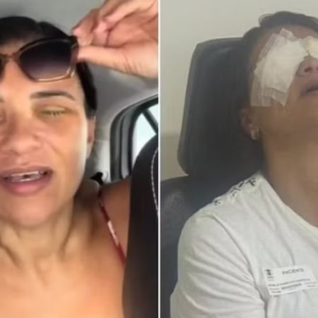 PERSONAL TRAINER SOFRE QUEIMADURA GRAVE NOS OLHOS APÓS USAR POMADA DE CABELO
